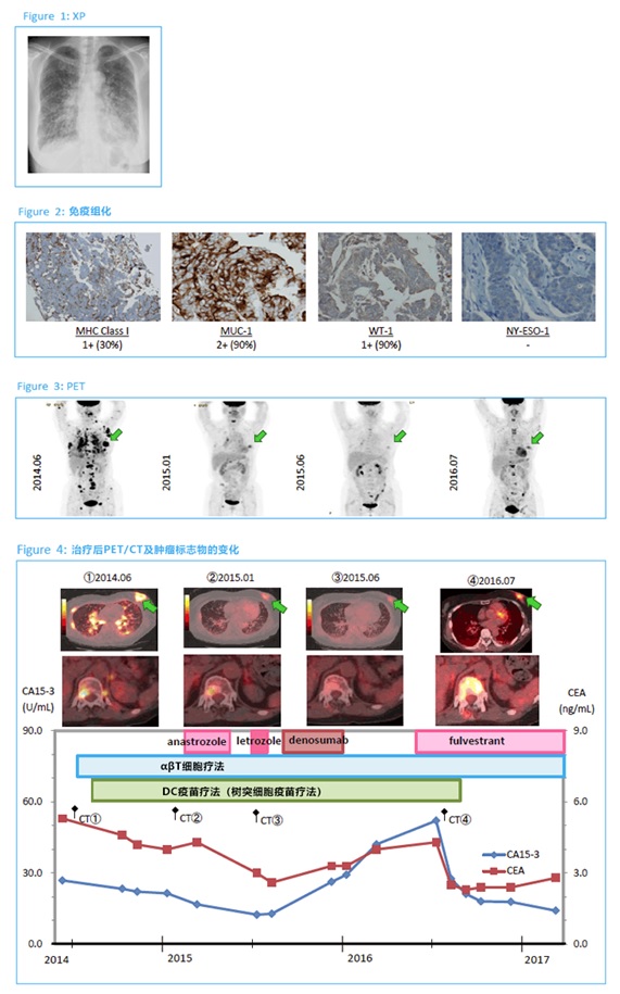 免疫細(xì)胞治療（αβT細(xì)胞療法+樹突細(xì)胞疫苗療法）治療乳腺癌奏效案例