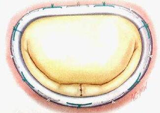 二尖瓣關閉不全的手術