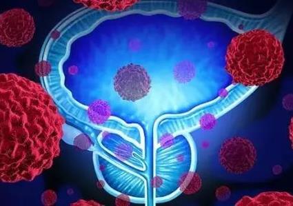 日本專家談腫瘤?前列腺癌